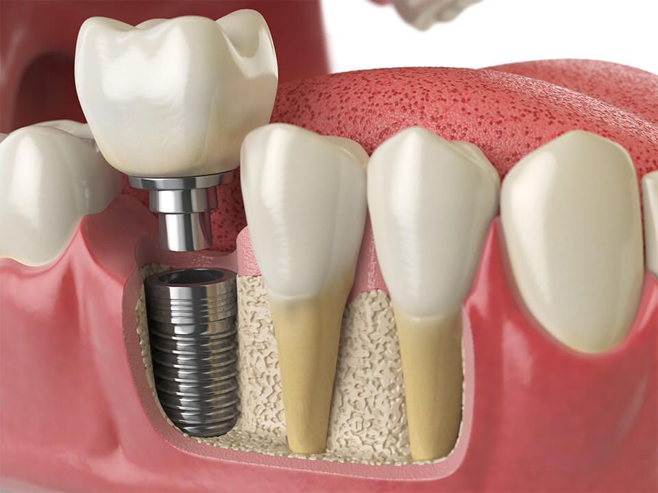 Dentiste – Édentement à Paris 9